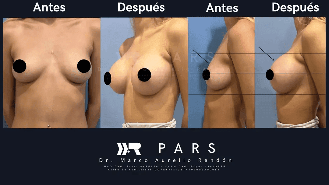 Four images showing different breast augmentation results. These were taken from different angles to clearly all the results.