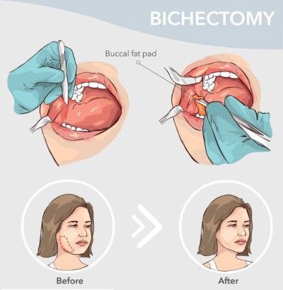 Illustration of different steps that are followed for the performance of the bichectomy, it serves as visual support drawings.